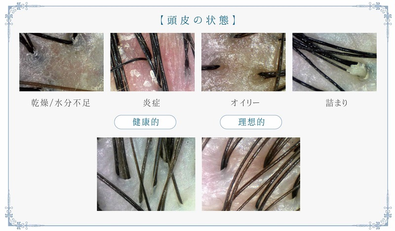 ヘッドスパ頭皮状態